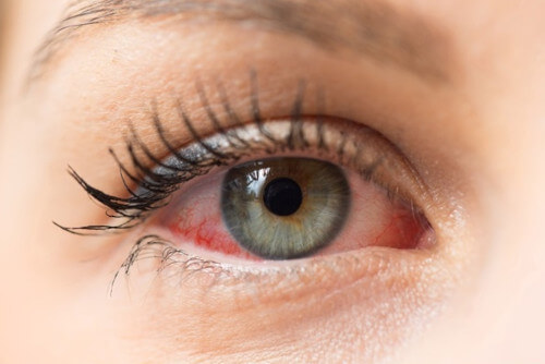 soczewki kontaktowe alergie oczu