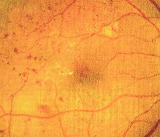 mikrotętniaki siatkówkowe w retinopatii cukrzycowej