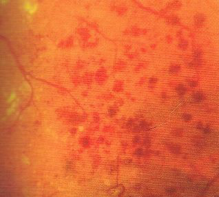 wybroczyny siatkówkowe w retinopatii cukrzycowej
