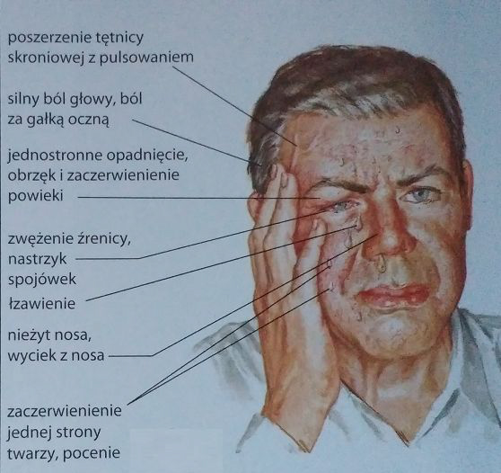 klasterowy ból głowy - objawy